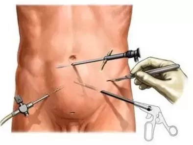 созылмалы простатитті хирургиялық емдеу